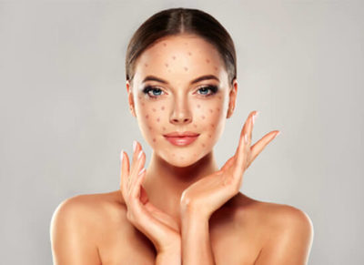 peau-acné soin-best concept-institut-de-beauté-marseille-13007